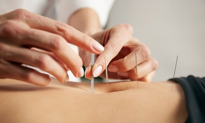 dry needling Behandlung